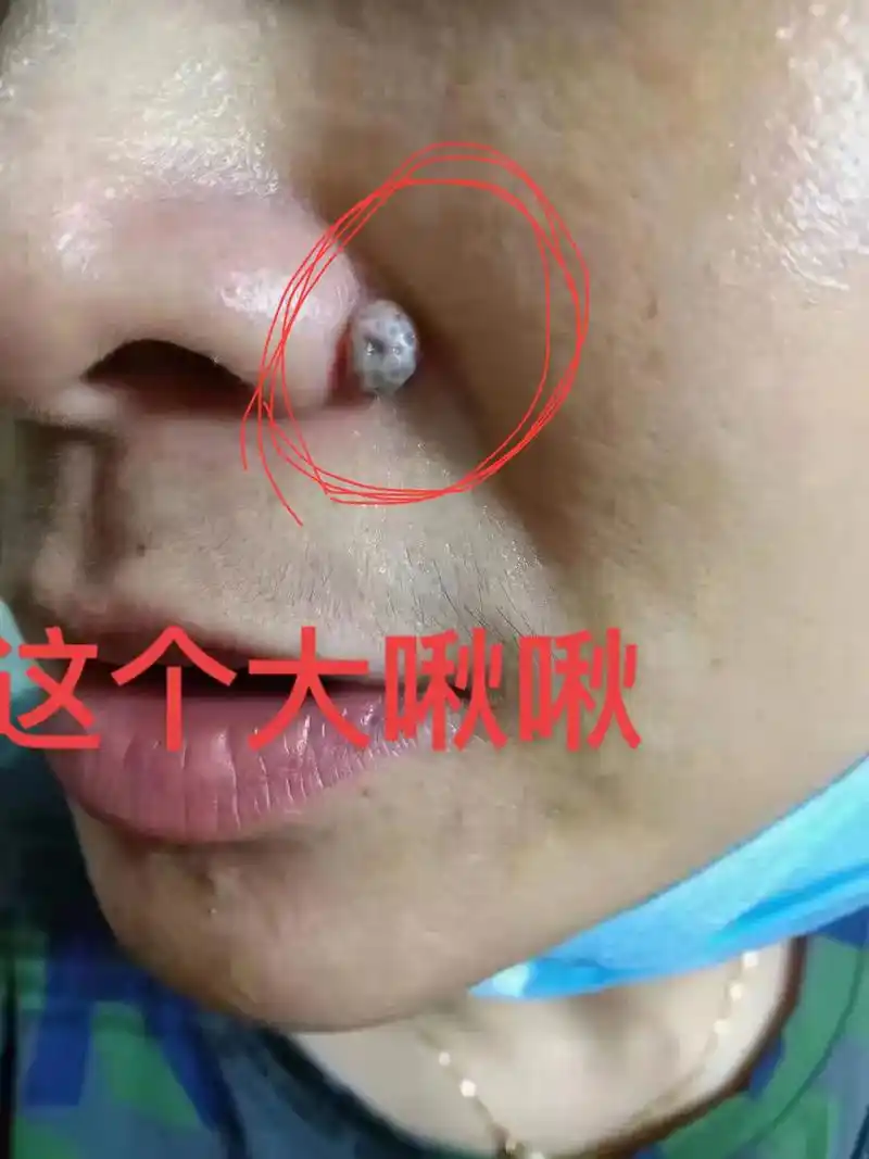 皮肤赘生物 #肉啾啾 - 抖音