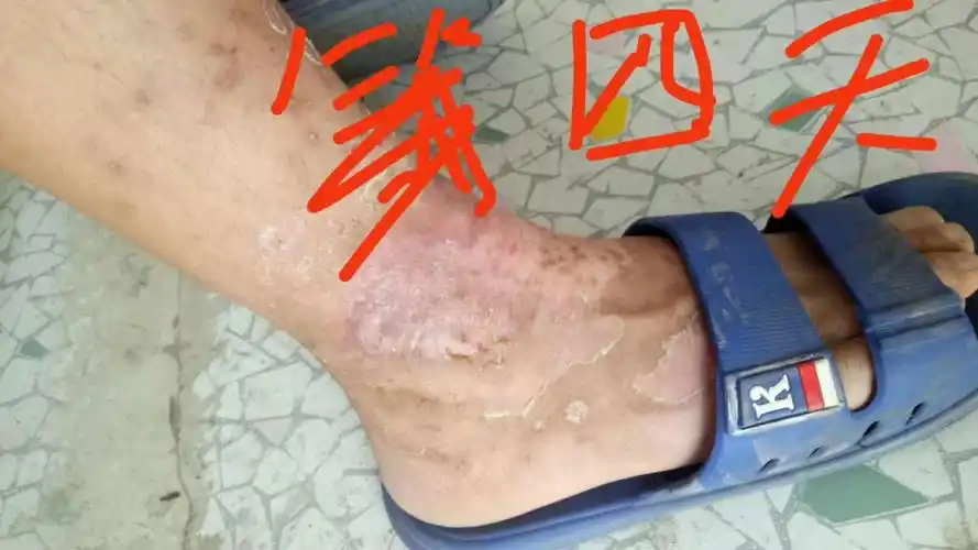 癣,用了皮肤膏一层一层剥皮,里面出现红色血液,表皮愈合了,喝了酒,吃