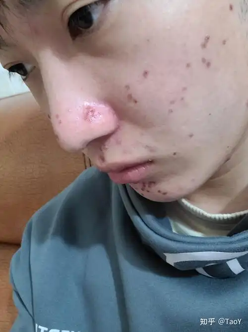 鼻子上凸起的增生痘疤怎么去除