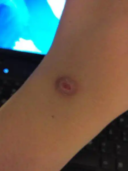 手腕上有个烟疤可以当兵吗?