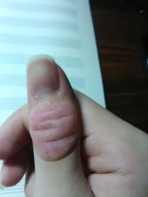 右手大拇指关节处长了个大包,如图,是小时候有个小包,结果不断去咬,咬