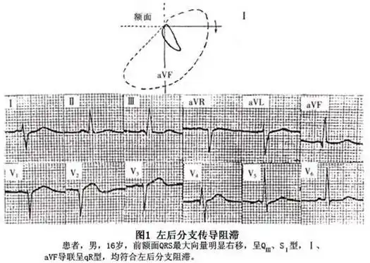 左后分支阻滞 - 老古董 - 老古董