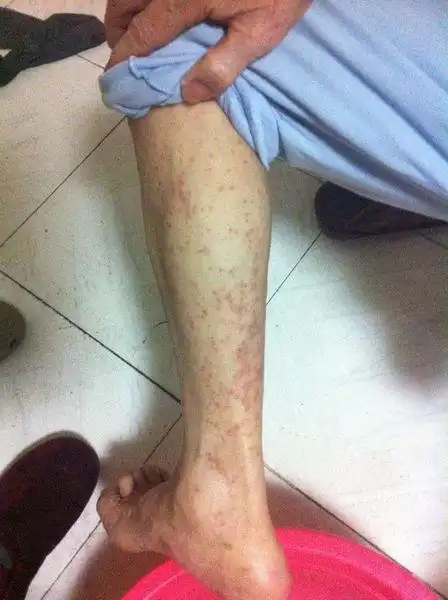 87岁老人身患糖尿病多年 2012年四月起开始身上起如图的红色疙瘩 还