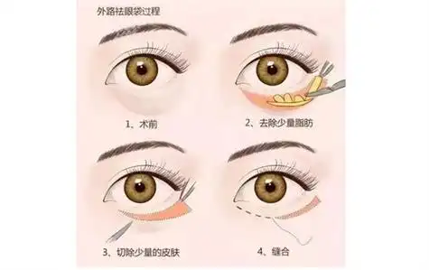 眼袋内切和外切区别哪个难度高还有不开刀去眼袋手术详解
