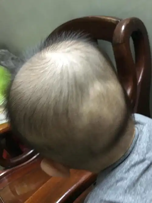 求助宝宝后脑勺凸起来什么情况