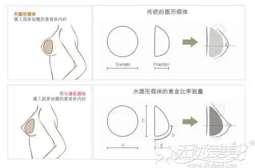 圆形假体和水滴形假体对比