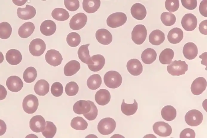 icsh外周血细胞形态特征的命名和分级标准化建议-配图  铁粒幼细胞