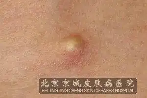 得了皮脂腺囊肿一定要治吗