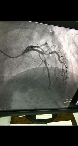 心脏循环有没有狭窄,下面这张图是一个有糖尿病,高血压的患者做的造影