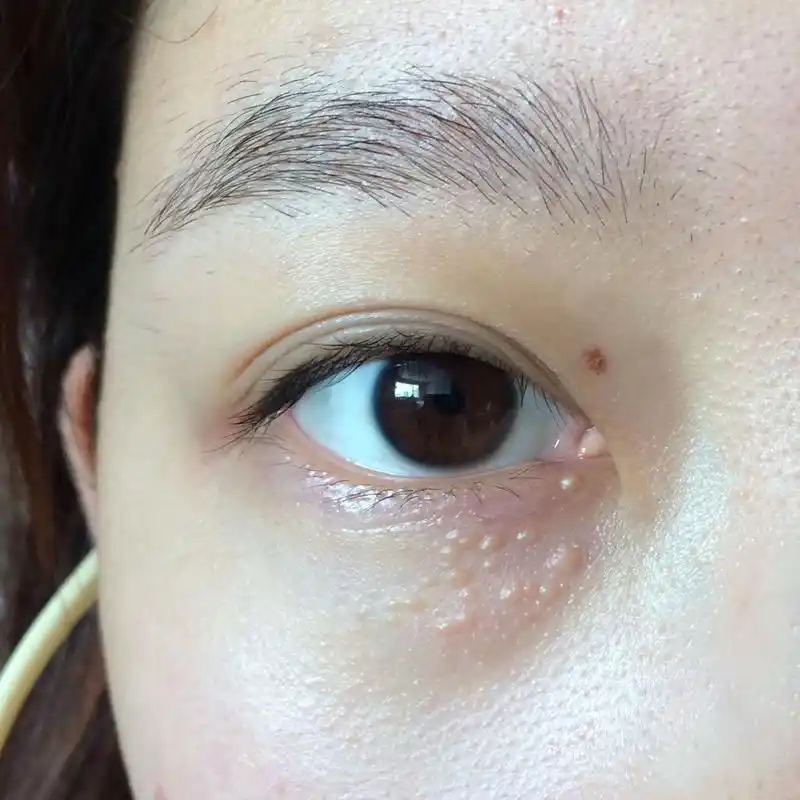 眼睛下长了很多小疙瘩,不是脂肪粒 长了七八年了,而且越涨越多,以前就