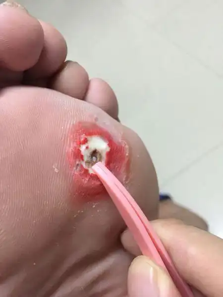 我贴了半个多月鸡眼贴,现在把能弄的都弄完了,就剩中间一个小肉柱,是