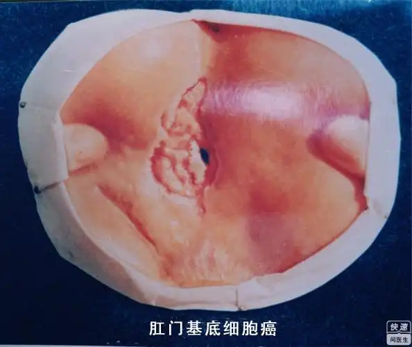 女性多见,而肛门周围癌在男性患者中更为多见.