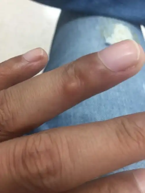手指上长了个大疙瘩,不疼不痒,是怎么回事呢