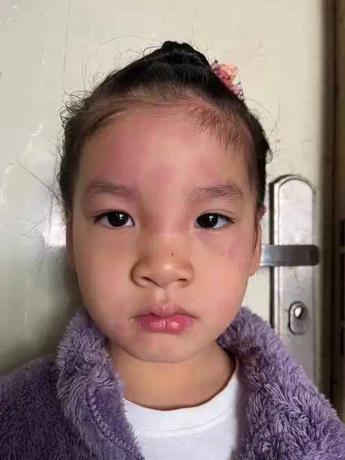 第一次发荨麻疹,我们老家叫发风坨,脸上和身上全部是大面积的红 - 抖