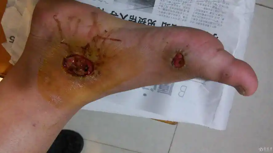 皮肤擦伤一月慢性溃疡有图片