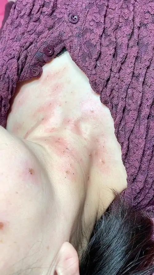 98 疣是人类乳头瘤病毒 在免疫力低下的情况下 自体传染,间接传染