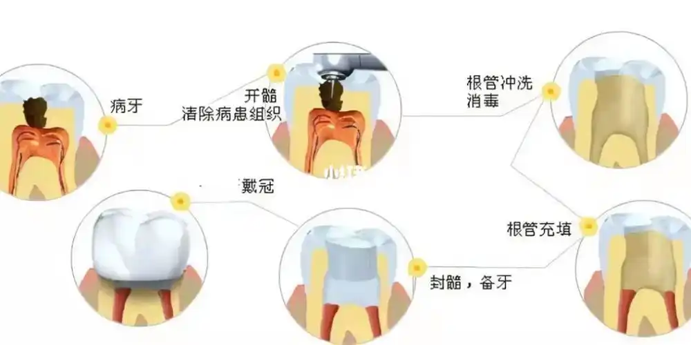 根管治疗后多久才能进行桩冠修复