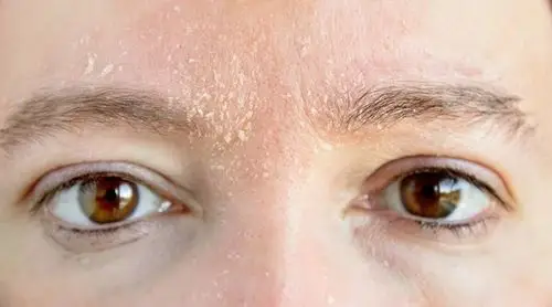 脸干怎么办,皮肤干燥如何应对?