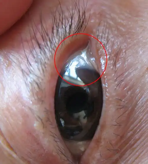 在黑眼球与白眼球交界处,长着白色的小膜,仔细看好像是从黑眼球里长