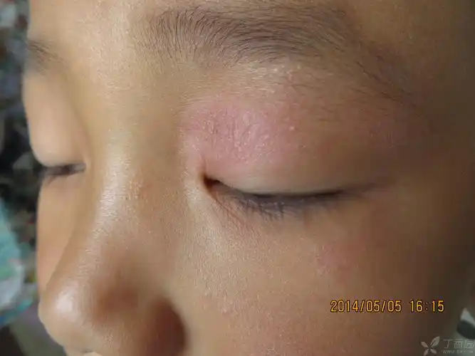 【请教】单侧上眼睑皮疹诊断湿疹正确吗