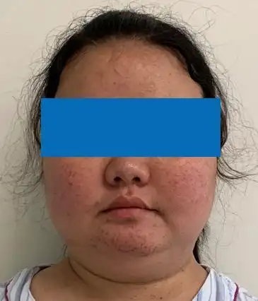 发询问她的病情,又看到她脸圆背厚,面色泛红,是典型的"满月脸,水牛背"