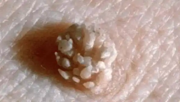 17岁高中生腿中间长满"菜花",医生:太无知!