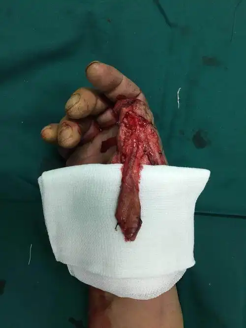 拇指筋膜皮瓣修复