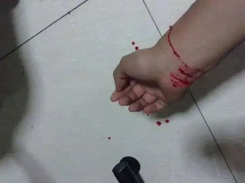 割手腕伤疤图片大全女 - 搜狗图片搜索