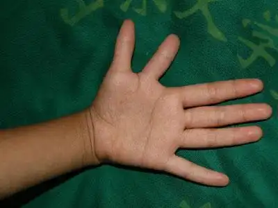 长6个手指头是怎样一种体验