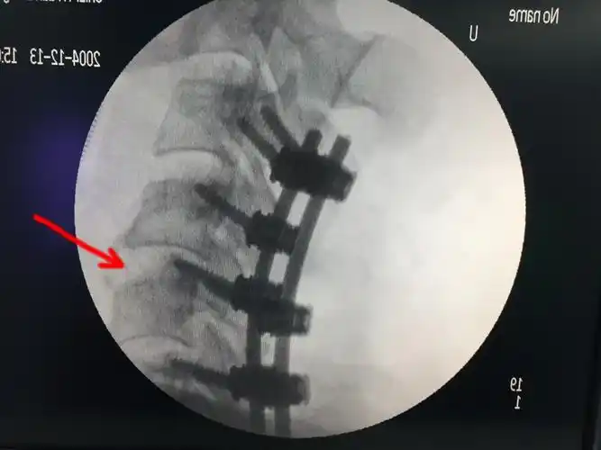 松解后复位成功,并行椎管减压侧块螺钉固定,术中显像满意