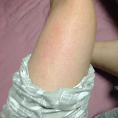 洗澡时发现大腿上一大片发红,不痒,有一点点痛,没有接触过什么过敏源