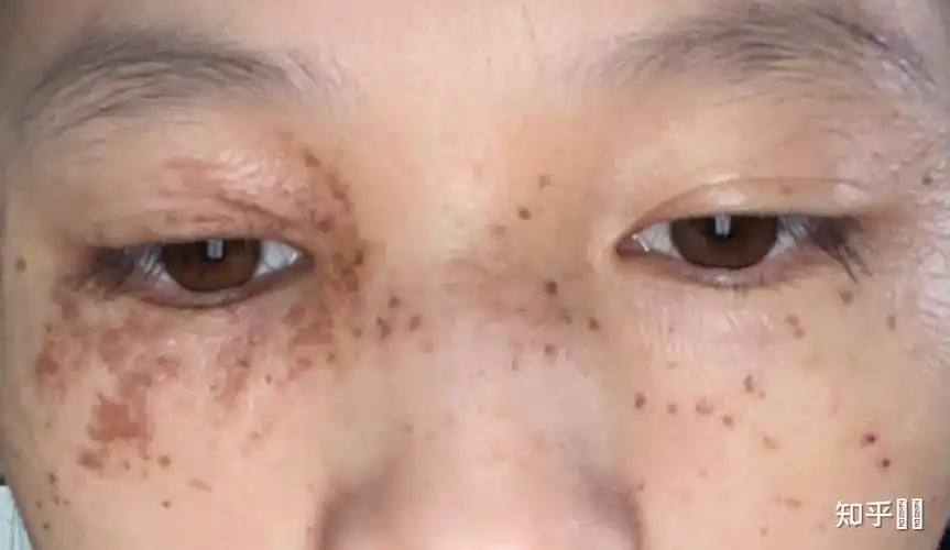 雀斑样痣有治愈的吗?哪里做的好? - 知乎