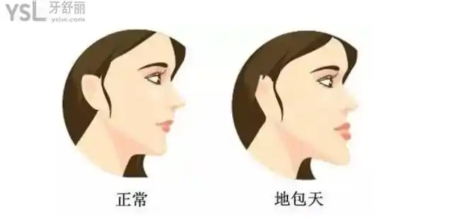 地包天侧脸对比