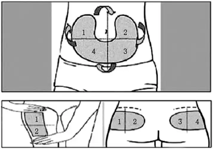 注射部位轮换方案:数字表示可供转换的不同区域