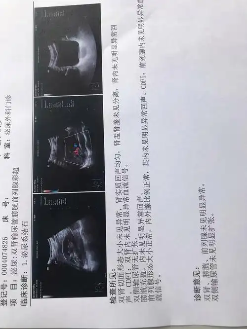 肾结石自排经历(成功排出)