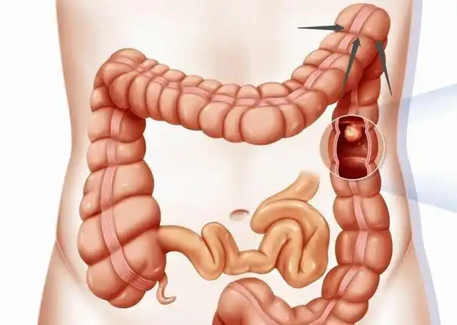 古今医案研读:这是一个结肠脾曲综合征的医案,辩证过程神同步