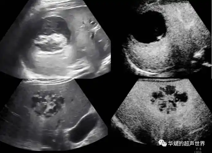 肝脏常见囊性病变的超声诊断与鉴别状|包虫囊肿|鉴别状|肝脓肿|肝脏