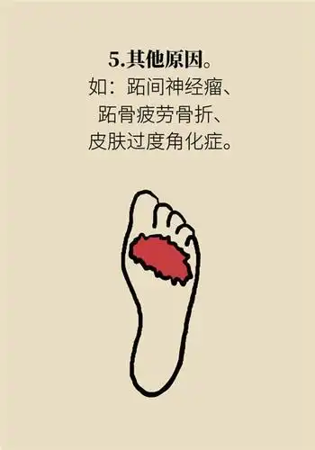 前脚掌起老茧一踩地就疼痛?当心这可能是跖痛症