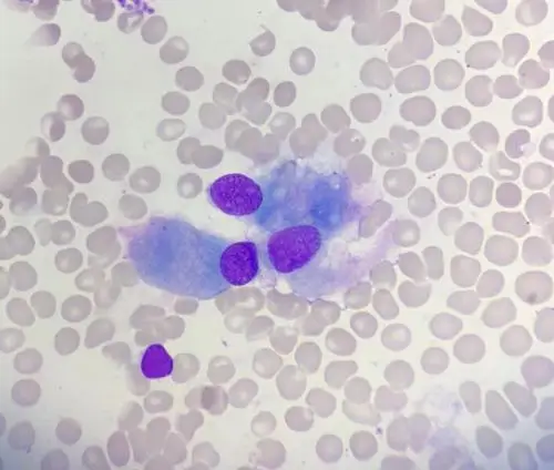 成骨,破骨,肥大,内皮,mott,脂肪,巨早幼红,毛细胞,淋巴瘤伴噬血细胞