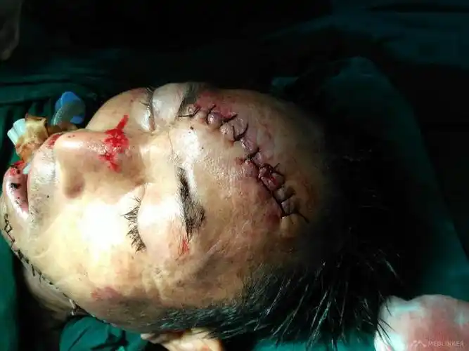 左面颊及额部刀伤一例-医联