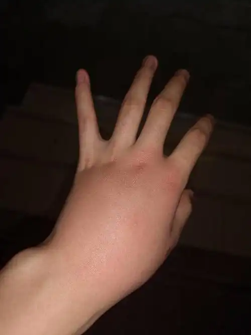 我这手是被虫子咬了,早上起来就肿了不知道什么虫子,怎么办