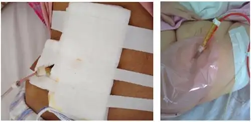 落实优质护理 护士"巧手"让生命享受阳光-曲靖市第二