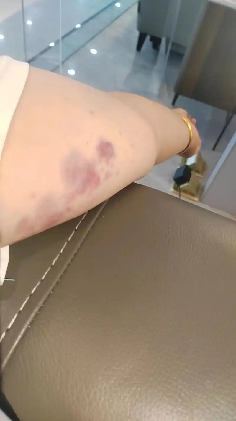 拍痧…昨天下午约了一个做胳膊拍痧的顾客(胖珊)胳膊的淤青就是 - 抖
