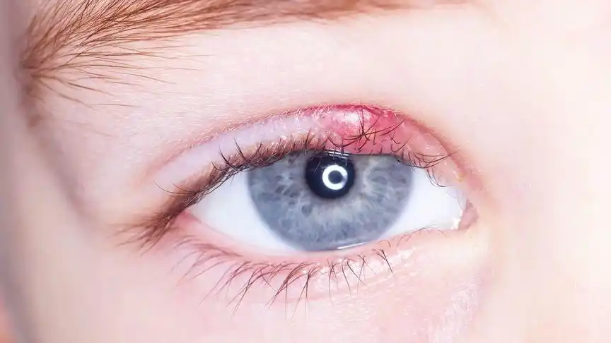 医生:细菌感染只是原因之一