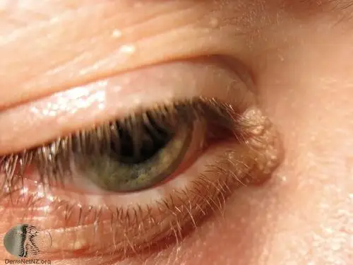 长在眼睛附近的扁平疣