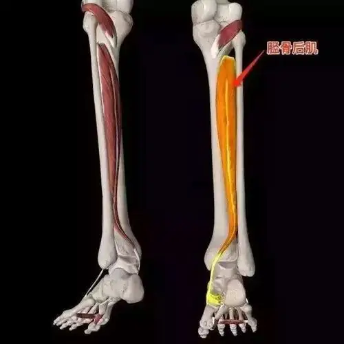 隐藏的足部杀手——胫骨后肌肌腱炎