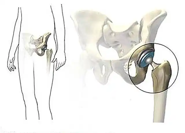 柳叶刀人工髋关节到底能用多少年科学家给出了答案