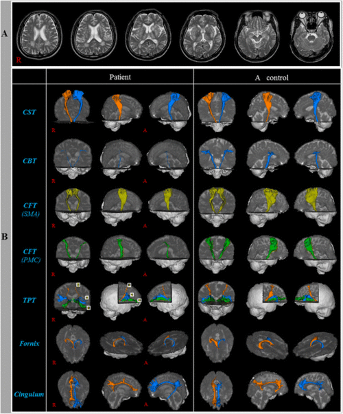 injuries of neural tracts in a patient with cadasil: a diffusion