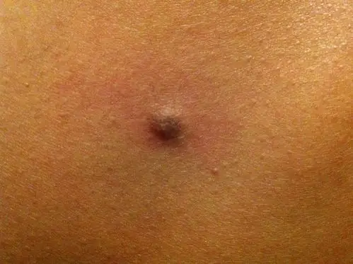 腰背部左侧长了一颗黄豆大小的黑色痘痘,不疼不痒,周围没有粗大毛孔.