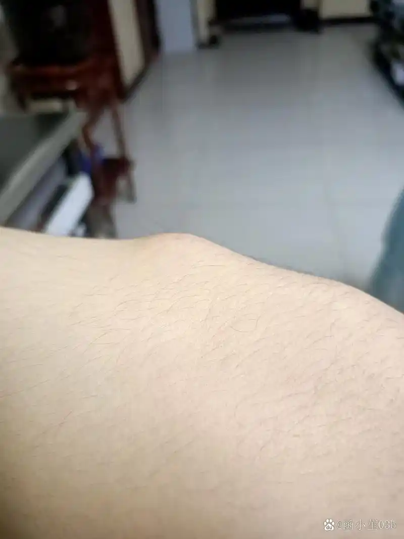 兄弟们我这个腿长了个包还不疼?这是什么症状?有能解答一下的吗?